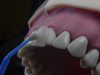 Dental Veneer Longevity