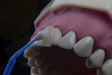Dental Veneer Longevity