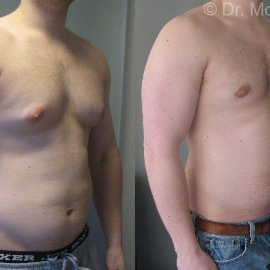 gynecomastia