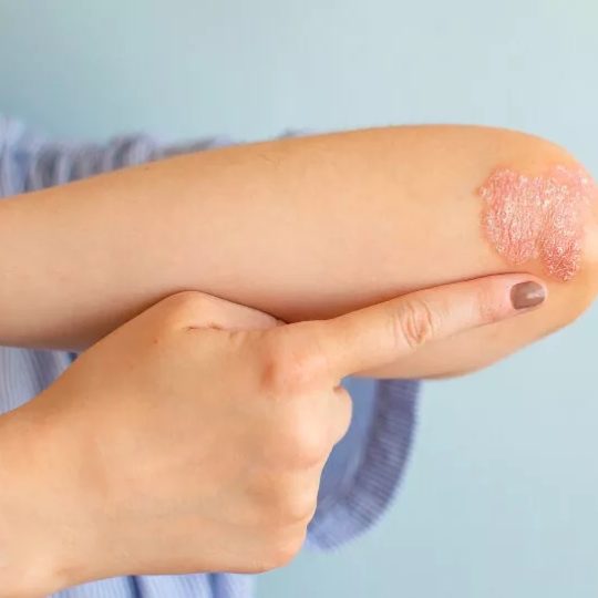psoriasis treatment