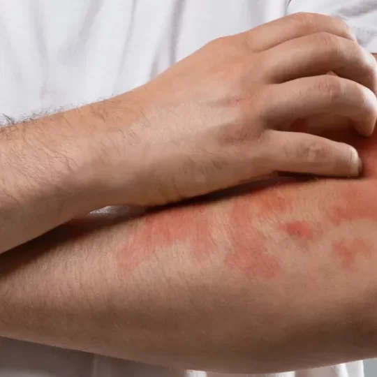 Seborrheic Dermatitis Symptoms