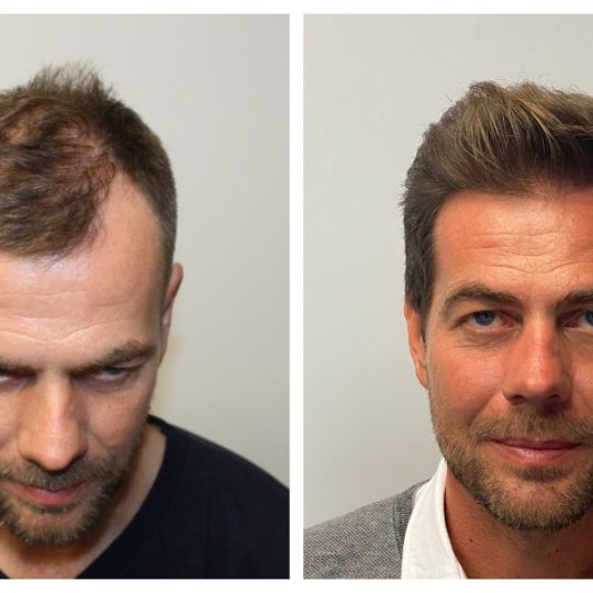 Hair Transplant